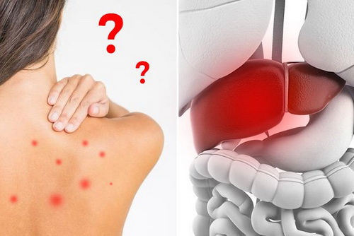Chăm sóc tổng hợp giúp giảm mụn lưng