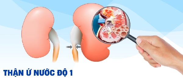 Ảnh biểu đồ minh họa sỏi thận gây ứ nước thận và các biến chứng