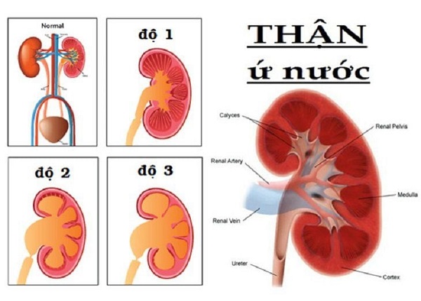 Hình ảnh thực tế siêu âm thận ứ nước do sỏi thận