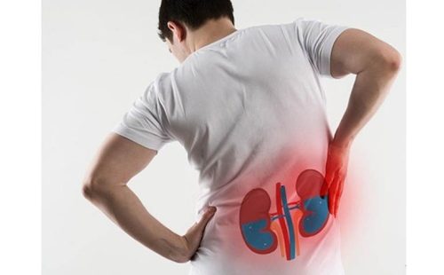 Giải pháp phòng ngừa sỏi thận hiệu quả an toàn