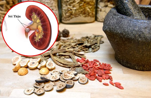 Các loại thảo dược hỗ trợ trị sỏi thận