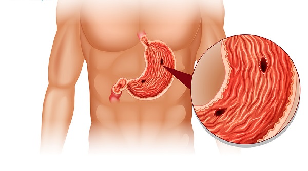 Rủi ro khi tự ý dùng thảo dược điều trị dạ dày