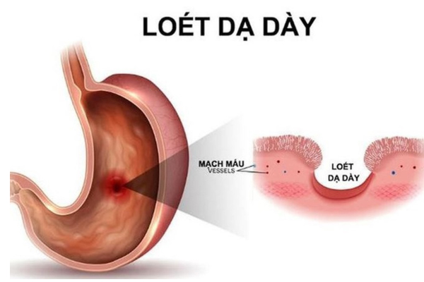 Thời gian điều trị viêm loét dạ dày phụ thuộc vào nhiều yếu tố