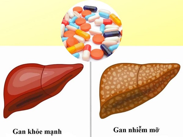 So sánh thuốc đặc trị viêm gan và thảo dược hỗ trợ