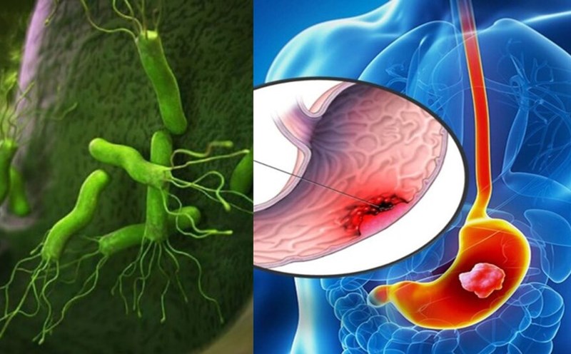 Phân biệt triệu chứng tiêu hóa kém và viêm dạ dày