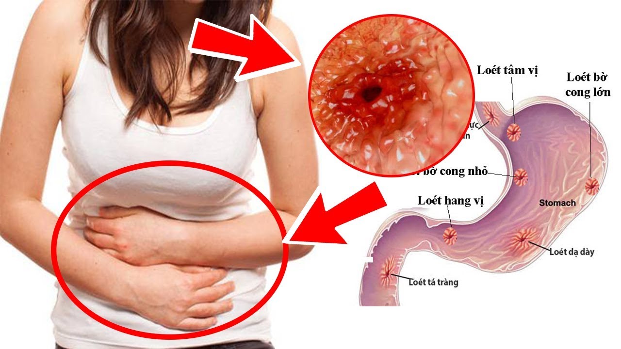 Cảnh báo rủi ro khi tự điều trị tiêu hóa bằng thảo dược không rõ nguồn gốc