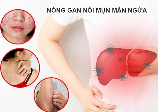 Triệu chứng nóng gan phổ biến