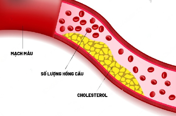Hệ quả khi sử dụng cà phê có phụ gia cho người mỡ máu