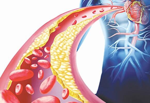 So sánh thuốc tây và thảo dược trị mỡ máu
