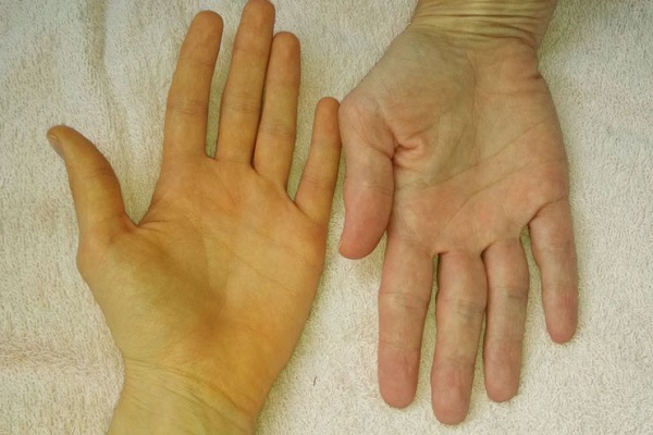 Hình minh họa vàng da và khô mắt do bệnh gan