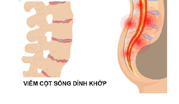 Ảnh minh họa bệnh nhân viêm cột sống dính khớp