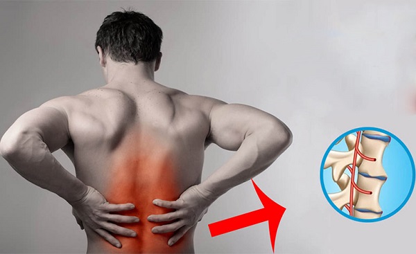 Biến chứng viêm cột sống dính khớp
