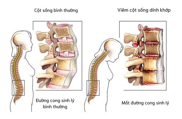 Viêm cột sống dính khớp có gây biến chứng không?