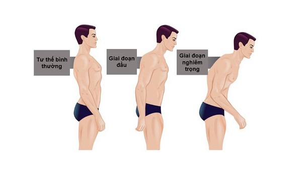Biến chứng do viêm cột sống dính khớp