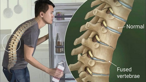 Phòng và hỗ trợ điều trị viêm cột sống dính khớp bằng thảo dược