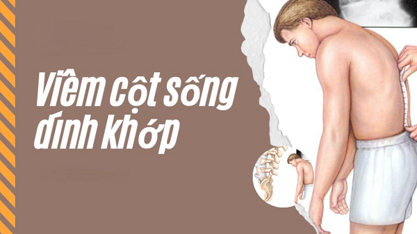 hình ảnh viêm cột sống dính khớp - trị tại nhà