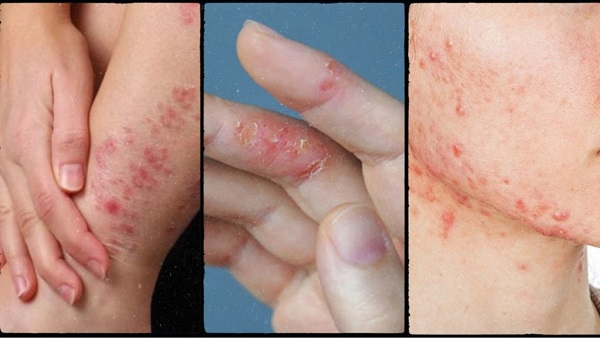 Viêm da cơ địa và nóng gan có liên quan gì nhau không?