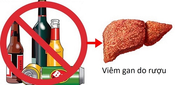 Viêm gan có cần kiêng hoàn toàn rượu bia?