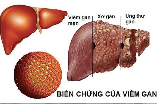 Hình ảnh liên quan đến viêm gan - nguy cơ ung thư