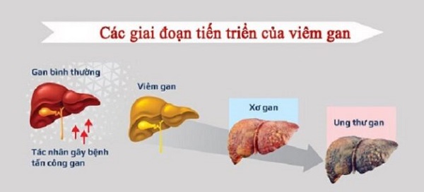 Các loại viêm gan và biến chứng nguy hiểm