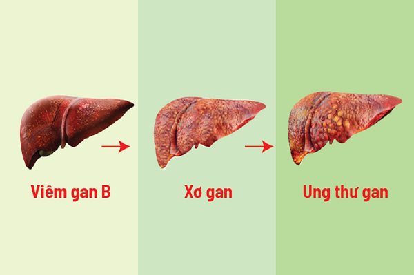 Bảo vệ gan, tránh nguy cơ ung thư