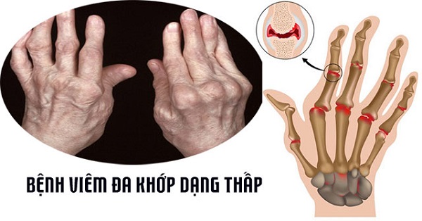Cận cảnh tổn thương của khớp và hình ảnh các loại thảo dược được tin dùng
