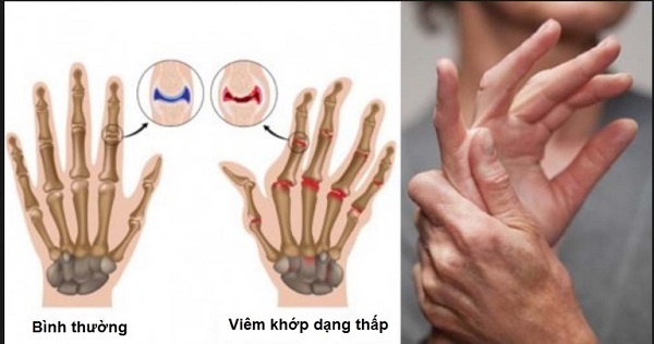 Hình ảnh minh họa lối sống lành mạnh và khám sức khỏe định kỳ phòng chống viêm khớp