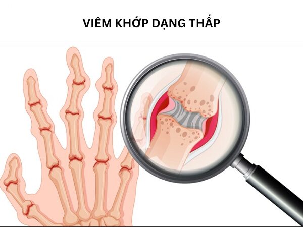 Ảnh minh họa người bệnh viêm khớp dạng thấp
