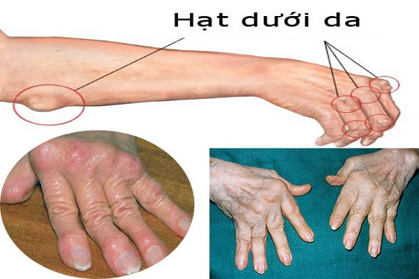 Biến chứng viêm khớp gây liệt vận động