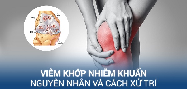 Các dấu hiệu và nguyên nhân viêm khớp nhiễm khuẩn