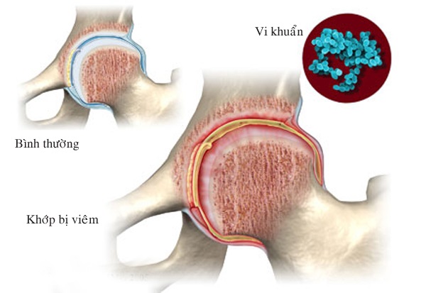 Chẩn đoán và nguy cơ khi tự ý điều trị viêm khớp