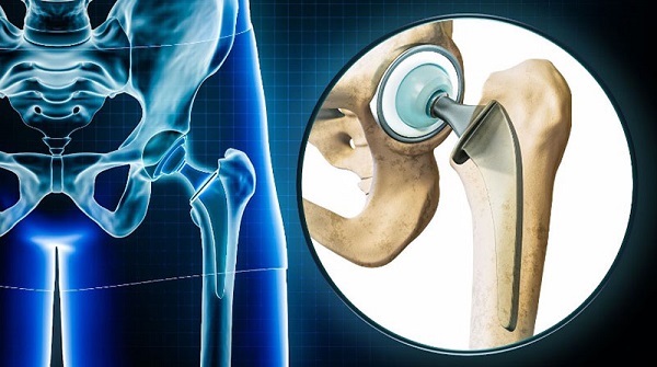 Viêm khớp nhiễm khuẩn có cần phẫu thuật