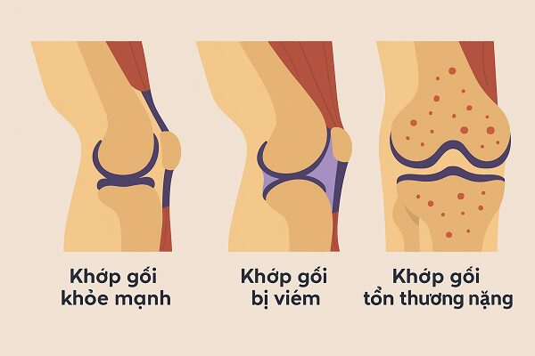 Lời khuyên phòng ngừa viêm khớp