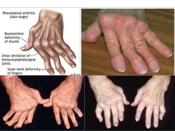 Viêm khớp nhiễm khuẩn và nguy cơ biến dạng khớp