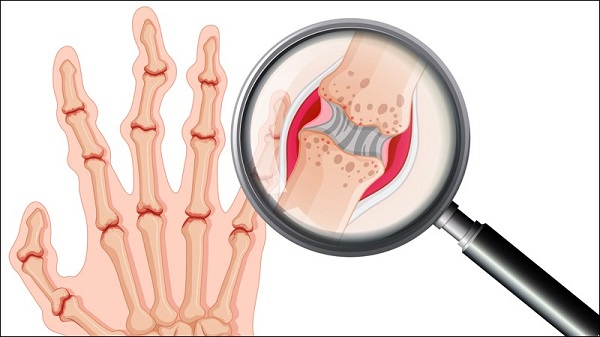Hình ảnh khớp biến dạng do viêm khớp nhiễm khuẩn