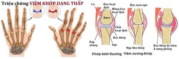 Hình ảnh so sánh viêm khớp dạng thấp và thái hóa khớp