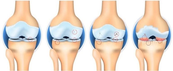 Viêm khớp dạng thấp với các triệu chứng điển hình