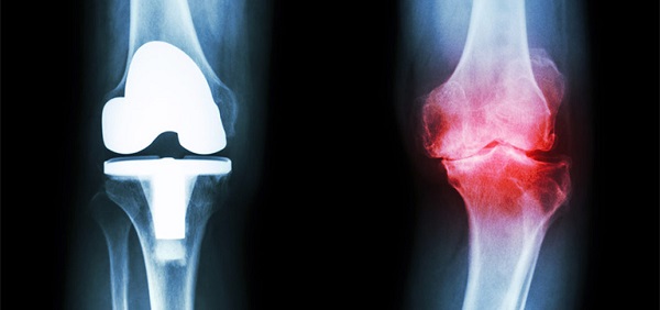 Cảnh báo rủi ro khi tự ý điều trị bệnh khớp