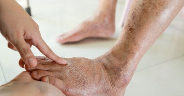 Vitamin B1 và vai trò trong phòng ngừa bệnh beriberi