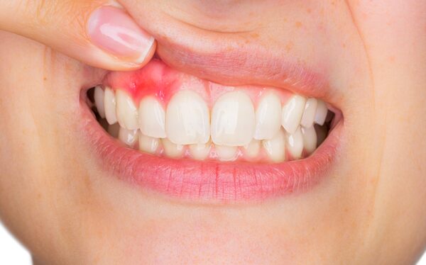 Hôi miệng do viêm lợi, viêm nha chu và mối nguy tiềm ẩn