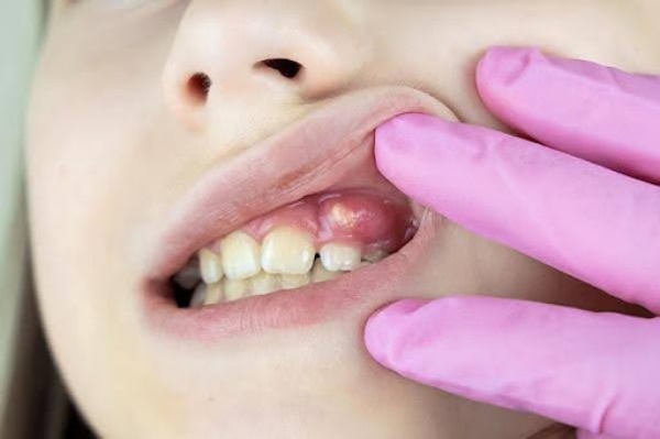 Vi khuẩn từ khoang miệng ảnh hưởng đến sức khỏe phổi