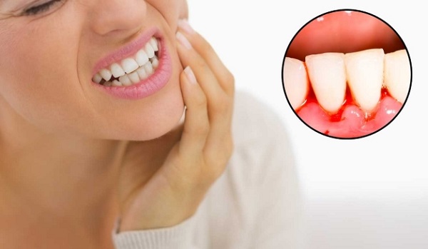 Viêm lợi, viêm nha chu làm tăng nguy cơ viêm phổi