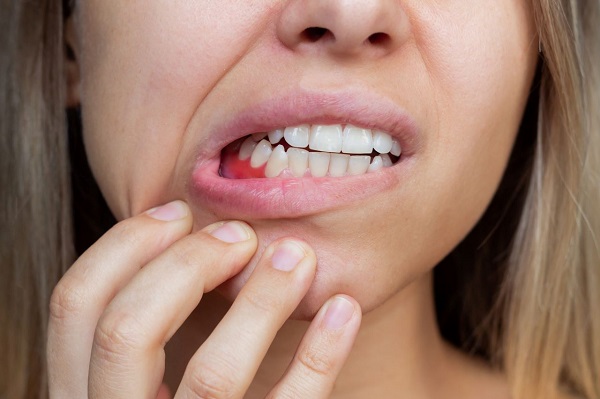Các giải pháp phòng ngừa viêm lợi, viêm nha chu bằng thảo dược thiên nhiên