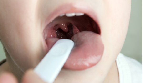 Amidan sưng đau nguy hiểm ở trẻ nhỏ
