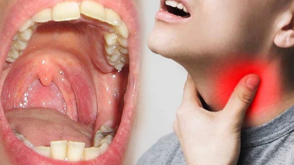 Viêm amidan có thể gây biến chứng áp-xe quanh họng