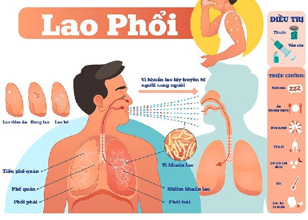 Minh họa lây lan lao phổi qua đường hô hấp