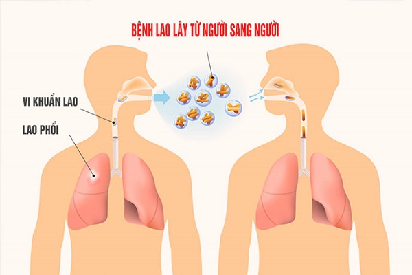 Vi khuẩn lao phổi dưới kính hiển vi