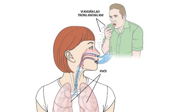 Không gian đông người – nguy cơ lây nhiễm lao phổi