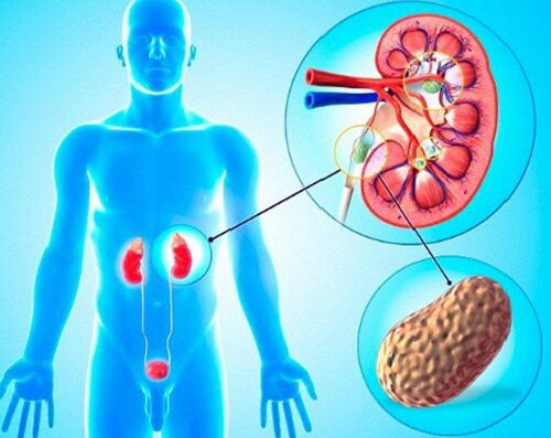 Lời khuyên phòng ngừa sỏi mật và sỏi thận