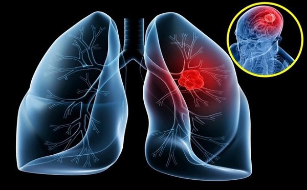 Hệ lụy của biến chứng ung thư phổi